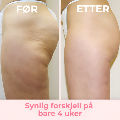 SilkRoller – Glattere hud på null tid!